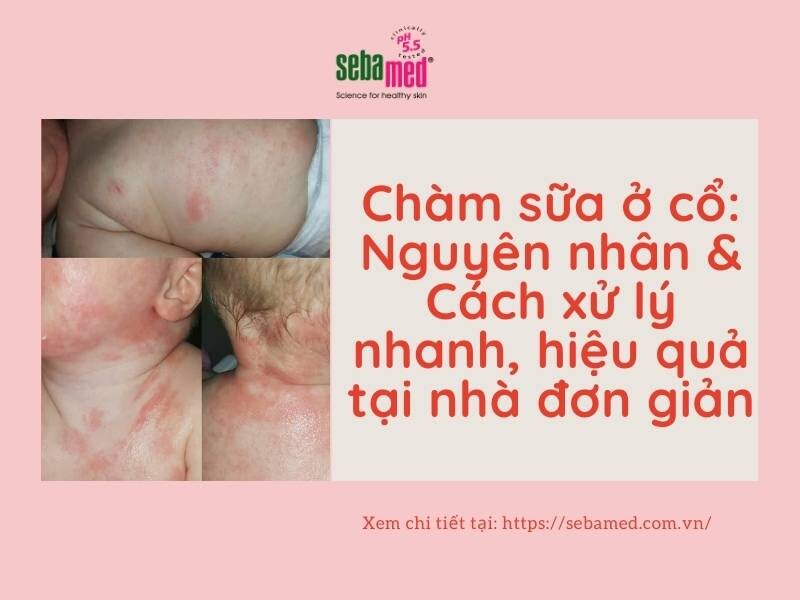 Chàm sữa ở cổ và cách xử lý nhanh mà hiệu quả