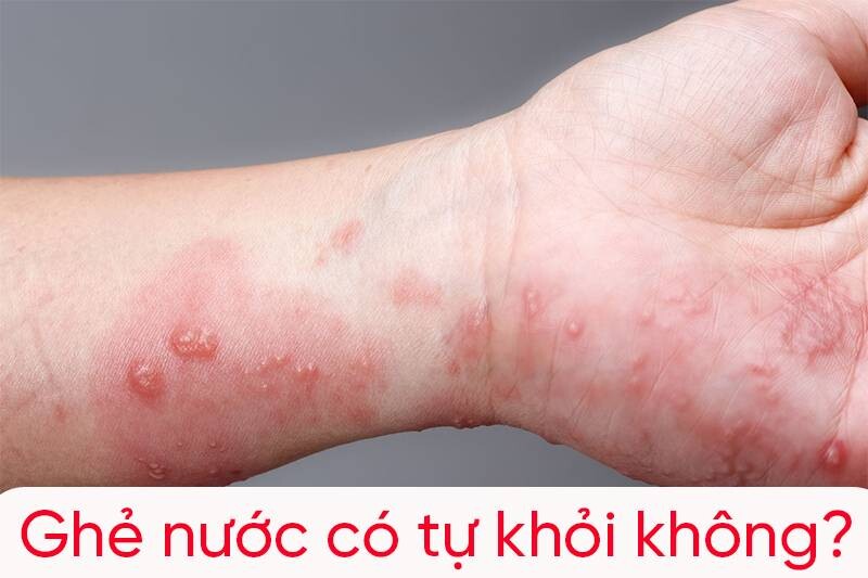Ghẻ nước có tự khỏi không? 1 - 1 Giải đáp: Ghẻ nước có tự khỏi không?