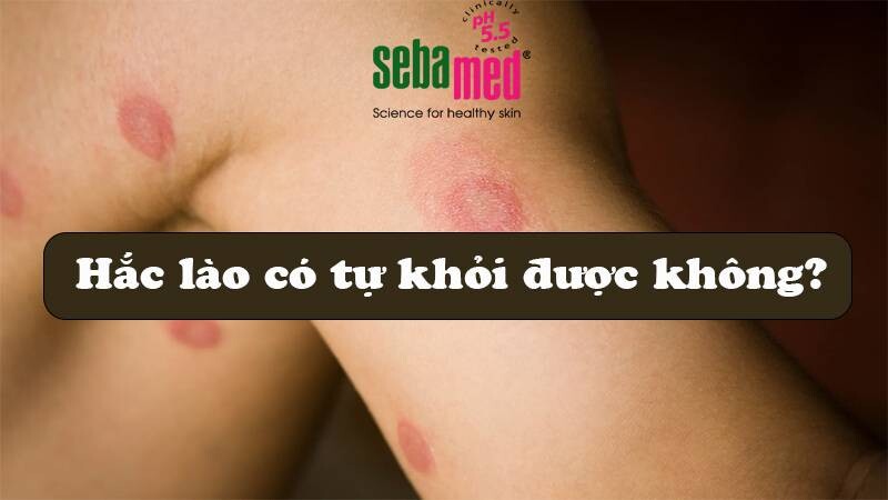 Hắc lào có tự khỏi không? Bị hắc lào bao lâu thì khỏi?