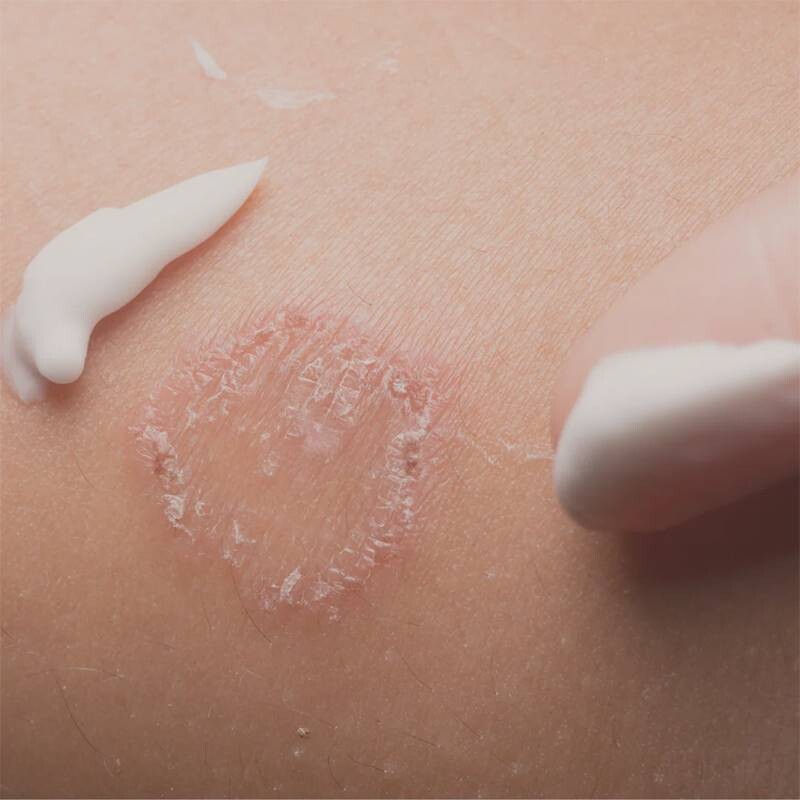 Nhìn chung, hắc lào sẽ giảm khả năng lây nhiễm sau 48 giờ điều trị và khỏi sau khoảng 4 tuần điều trị.