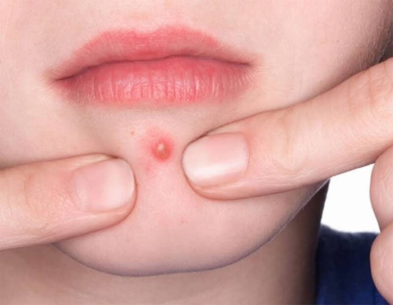 Mụn bọc ở cằm: Nguyên nhân và cách điều trị 4 - 4 Mụn bọc ở cằm có nên nặn không? Câu trả lời là KHÔNG.