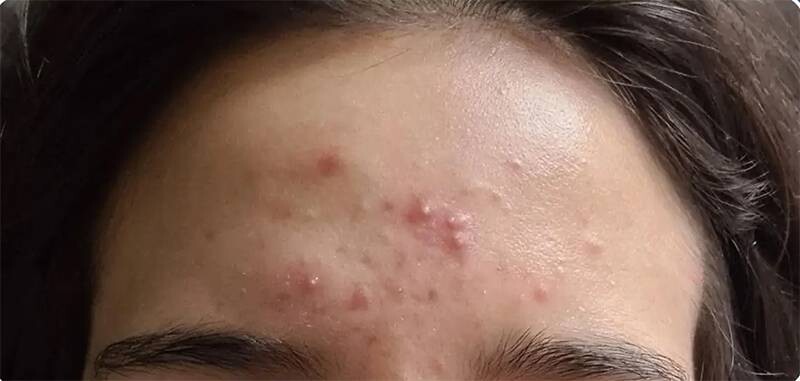 Mụn bọc ở trán: Nguyên nhân, cách chữa và phòng ngừa