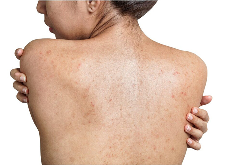 Mụn lưng: Nguyên nhân, phân loại, triệu chứng và cách điều trị.