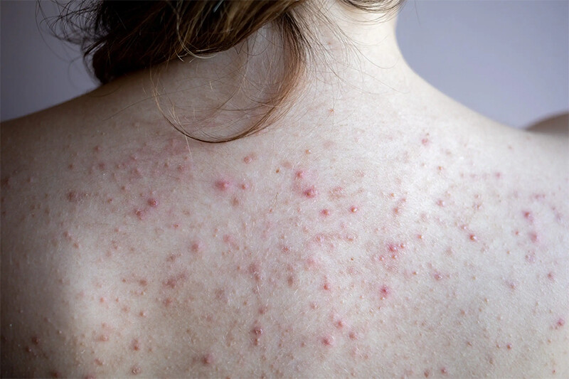 Tìm hiểu mụn lưng là gì?