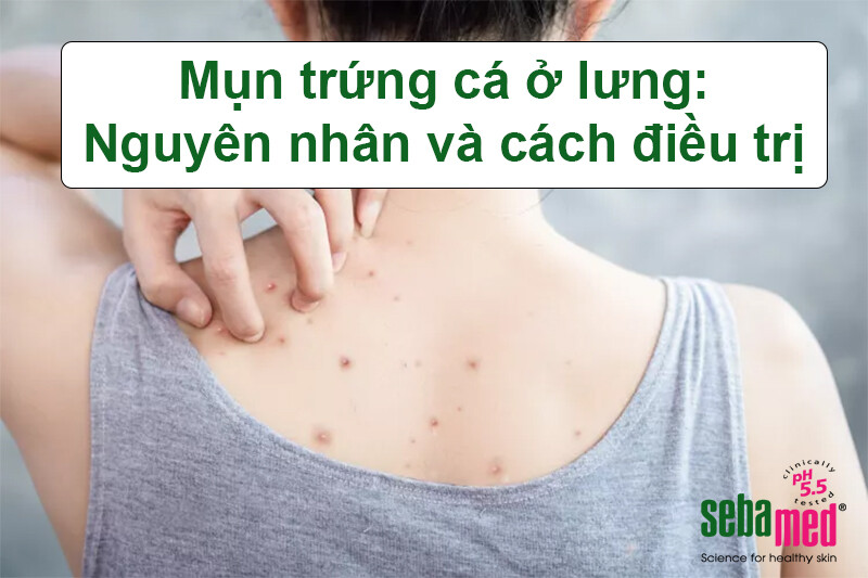 Mụn trứng cá ở lưng: Nguyên nhân và cách phòng ngừa