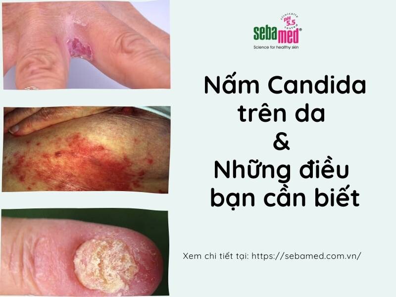 Nấm Candida trên da và những điều bạn cần biết