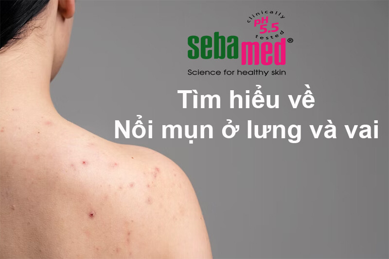 Nổi mụn ở lưng và vai: Nguyên nhân và cách điều trị