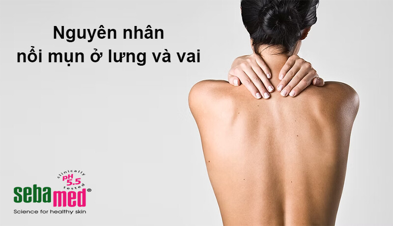 Các nguyên nhân nổi mụn ở lưng và vai.