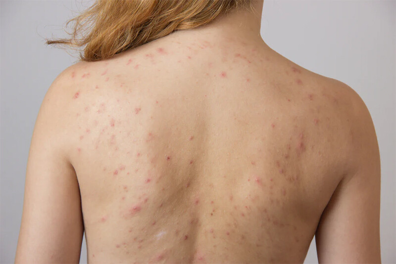Chú ý sử dụng kem chống nắng loại tốt để giảm sẹo và mụn thâm ở lưng và vai.