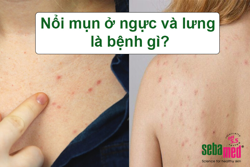 Nổi mụn ở ngực và lưng là bệnh gì?