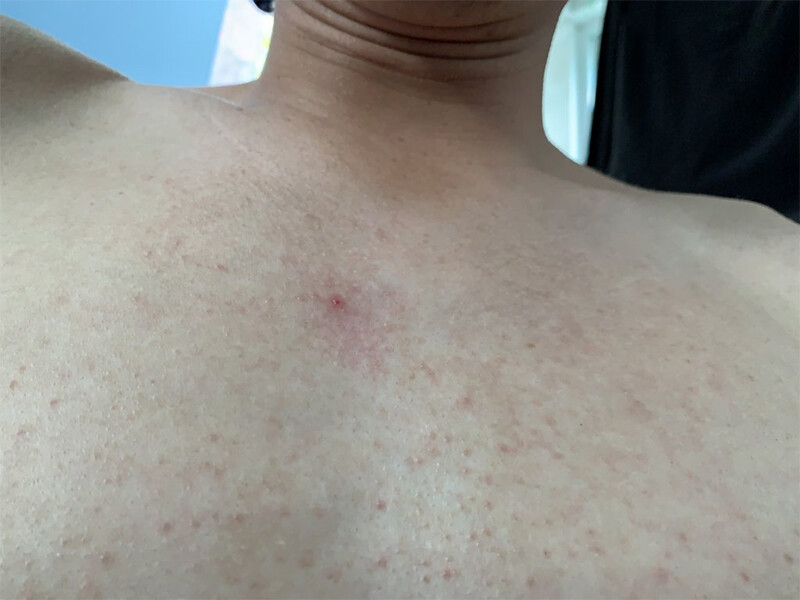 Nổi mụn ở ngực và lưng là bệnh gì? 4 - 4 Nổi mụn ở ngực và lưng là bệnh gì? Một số lưu ý các bạn cần biết.