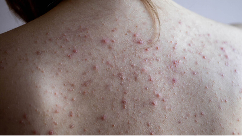 Nổi mụn ở ngực và lưng là bệnh gì? 5 - 5 Noi Mun O Nguc Lung La Benh Gi 4