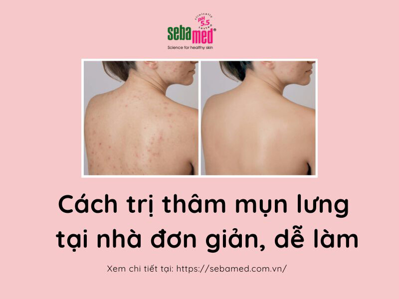 15+ Cách trị thâm mụn lưng tại nhà đơn giản, dễ làm.