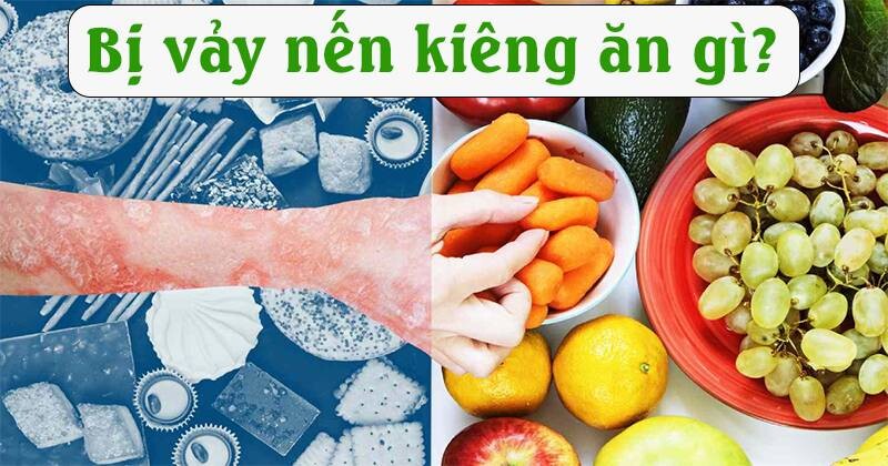 Bị vảy nến kiêng ăn gì? 2 - 2 Bị vảy nến kiêng ăn gì?