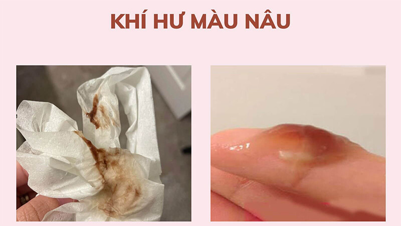 4 Cách trị khí hư màu nâu tại nhà đơn giản mà hiệu quả 2 - 2 Nguyên nhân huyết trắng có màu nâu.