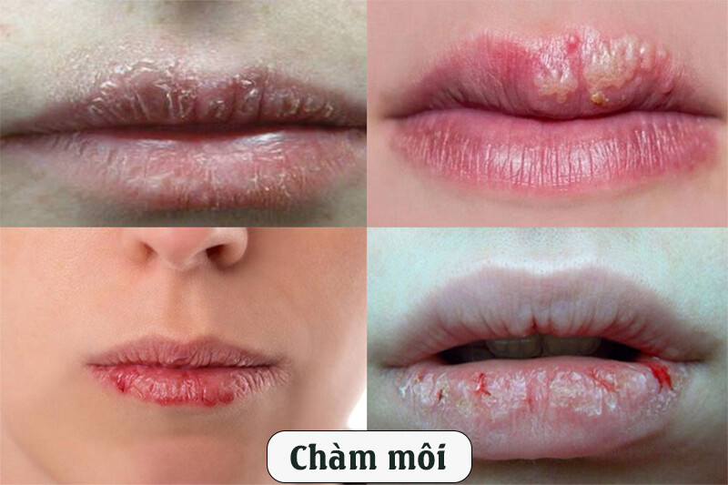 Chàm môi: 4 Nguyên nhân, cách chữa và cách phòng ngừa hiệu quả 1 - 1 Chàm môi: Nguyên nhân, cách chữa và cách phòng ngừa hiệu quả.