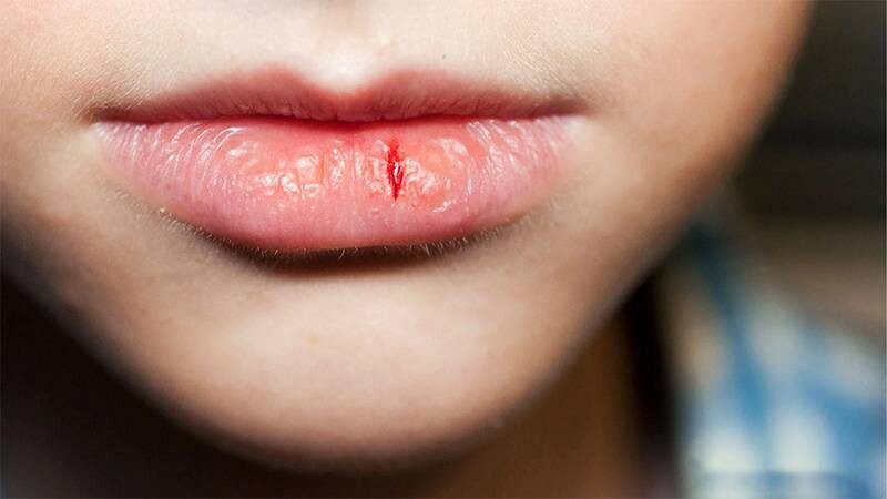Chàm môi: 4 Nguyên nhân, cách chữa và cách phòng ngừa hiệu quả 2 - 2 Dấu hiệu, triệu chứng nhận biết chàm môi.