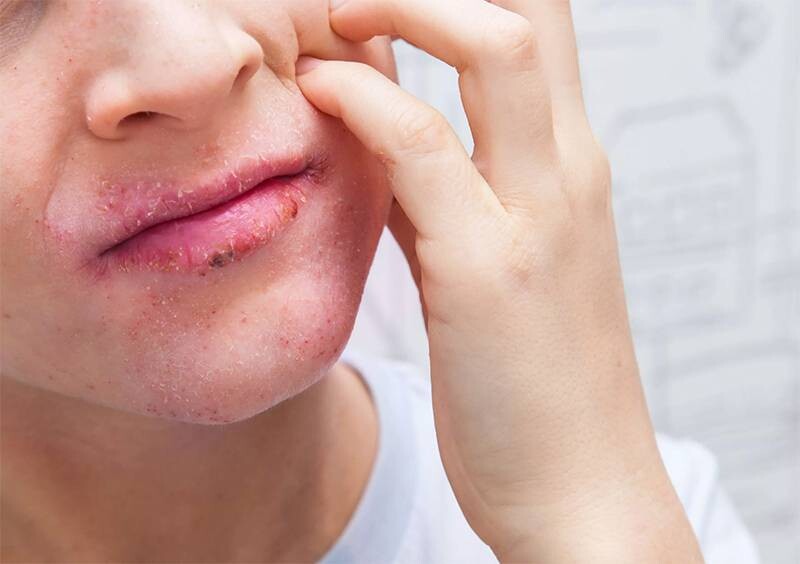 Chàm môi: 4 Nguyên nhân, cách chữa và cách phòng ngừa hiệu quả 3 - 3 Chàm môi có tự khỏi không? Câu trả lời là KHÔNG.