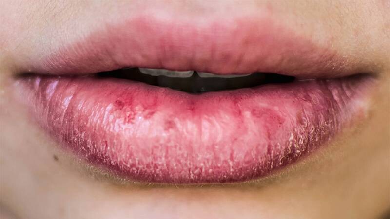 Chàm môi: 4 Nguyên nhân, cách chữa và cách phòng ngừa hiệu quả 5 - 5 Hướng dẫn cách phòng ngừa chàm môi tái phát.