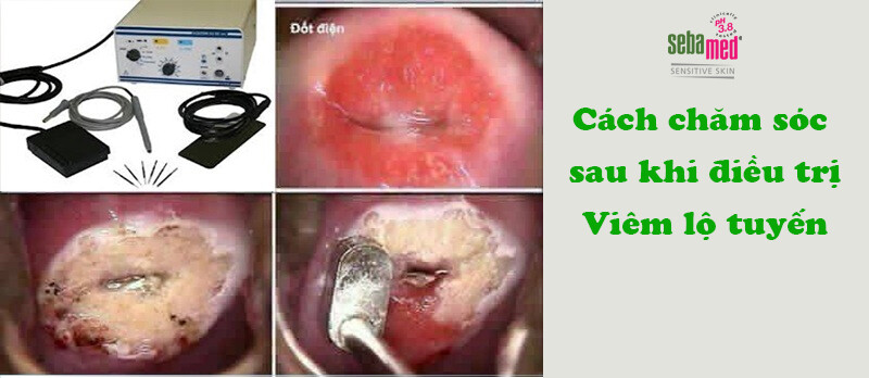 Viêm lộ tuyến độ 2 điều trị bao lâu khỏi? Có đốt được không? 4 - 4 Hướng dẫn cách chăm sóc sau khi đốt điều trị viêm lộ tuyến cổ tử cung.