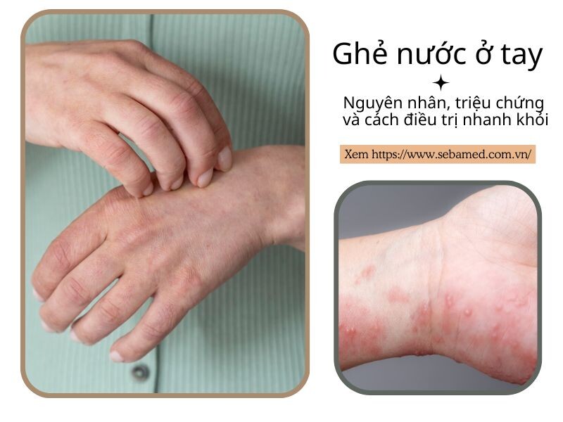 Ghẻ nước ở tay: Nguyên nhân, triệu chứng và cách điều trị nhanh khỏi