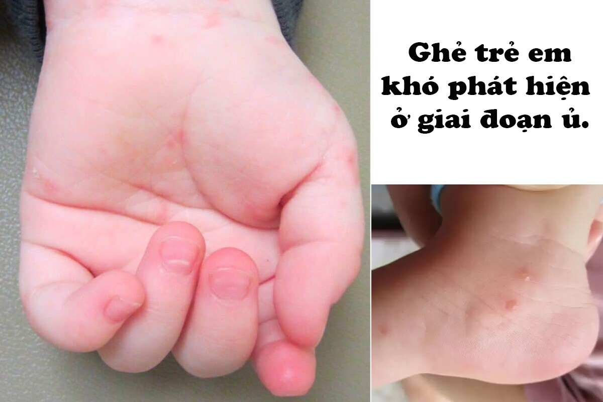 Các giai đoạn ghẻ nước ở trẻ: Giai đoạn ủ thường ít phát hiện ra.