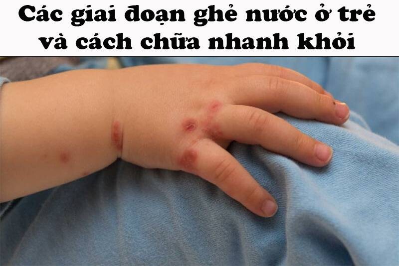 Các giai đoạn ghẻ nước ở trẻ và cách chữa nhanh khỏi