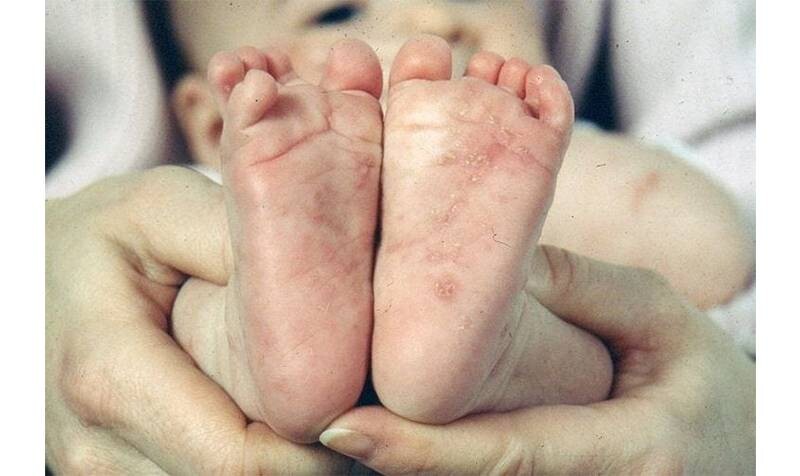Tìm hiểu các giai đoạn ghẻ nước ở trẻ.