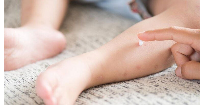 Ghẻ nước ở trẻ giai đoạn 1 được chữa sớm sẽ nhanh khỏi và ít để lại sẹo trên da.