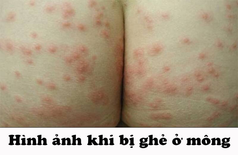 Hình ảnh ghẻ ở mông thực tế.