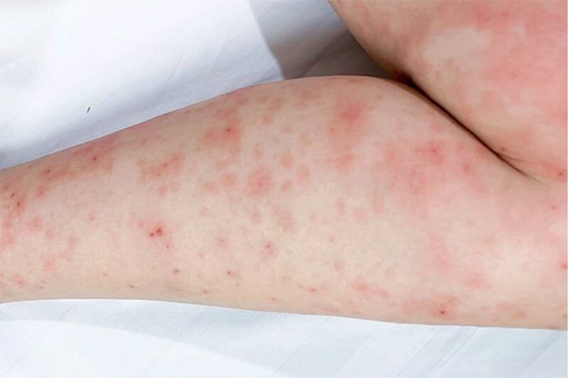 Ghẻ ở mông là bị ở vùng da ít khi xuất hiện ngoại, dễ bị biến chứng nhiễm trùng.