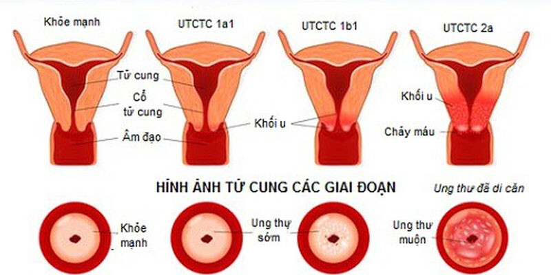 Cổ tử cung láng là sao? Có thể bạn chưa biết 2 - 2 Hinh Anh Co Tu Cung Lang