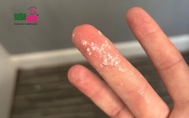 Khí hư bã đậu là gì? Nguyên nhân và cách điều trị