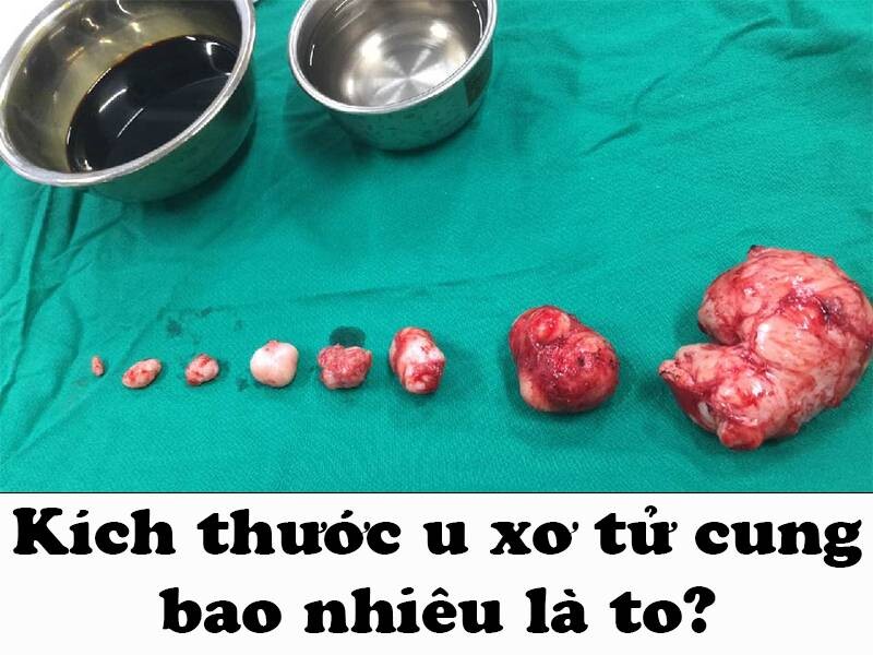Kích thước u xơ tử cung bao nhiêu là to?