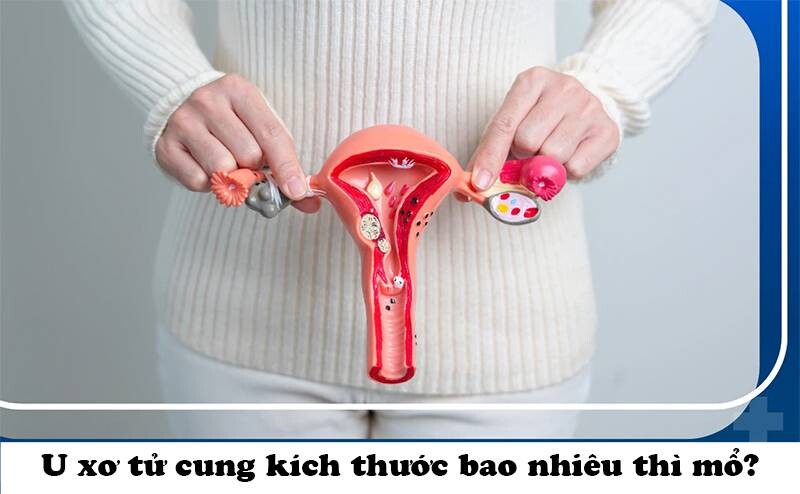 Kích thước u xơ tử cung bao nhiêu là to? U xơ tử cung kích thước bao nhiêu thì mổ?