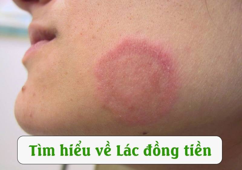 Lác đồng tiền: Nguyên nhân, dấu hiệu, cách điều trị chuẩn