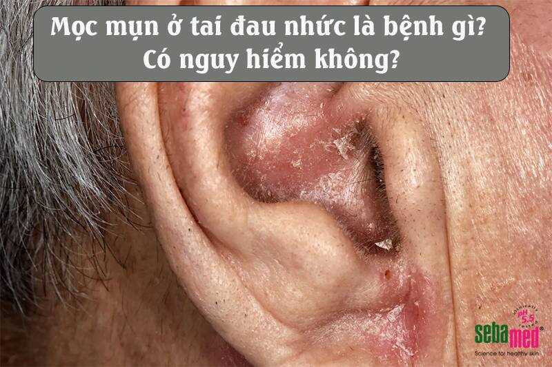 Mọc mụn ở tai đau nhức là bệnh gì? Có nguy hiểm không? 1 - 1 Mọc mụn ở tai đau nhức là bệnh gì? Có nguy hiểm không?