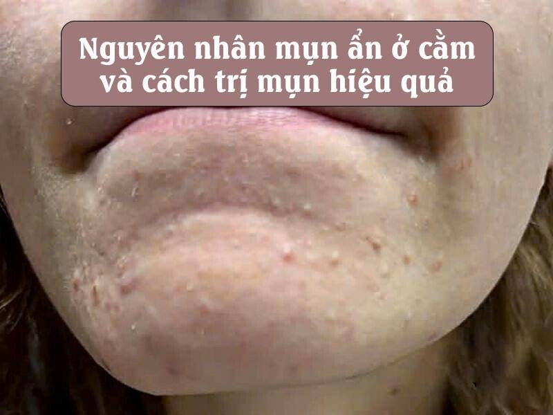 Mụn ẩn ở cằm: Nguyên nhân và cách trị mụn hiệu quả