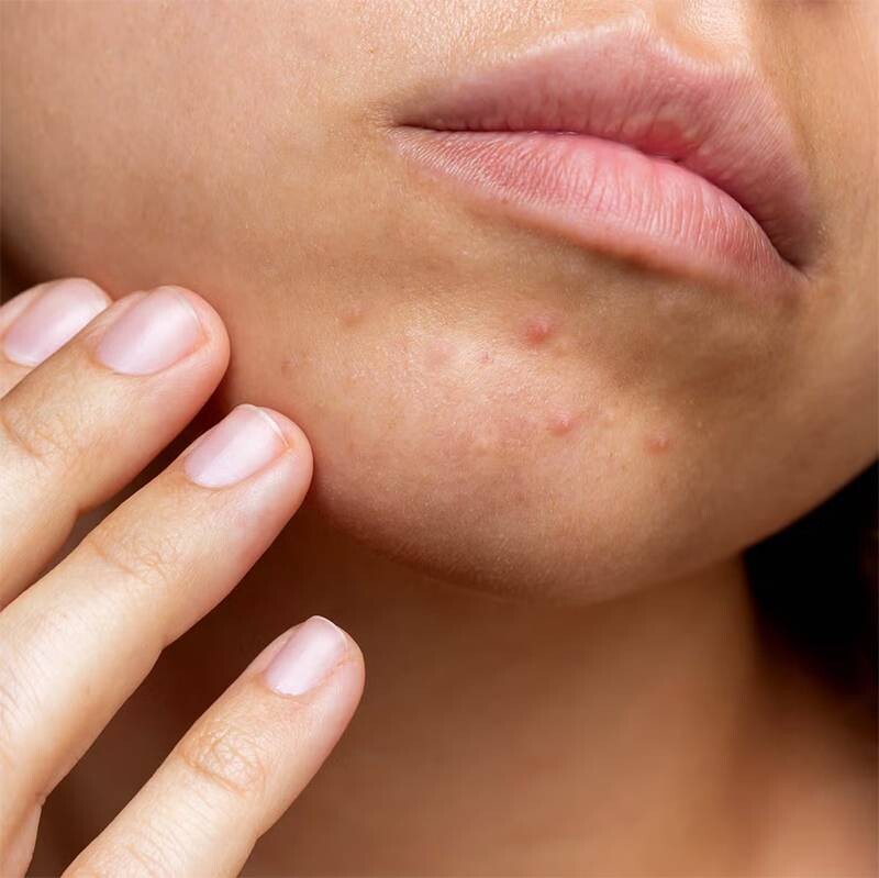 Mụn ẩn ở cằm: Nguyên nhân và cách trị mụn hiệu quả 1 - 1 Mụn ẩn dưới cằm là gì?