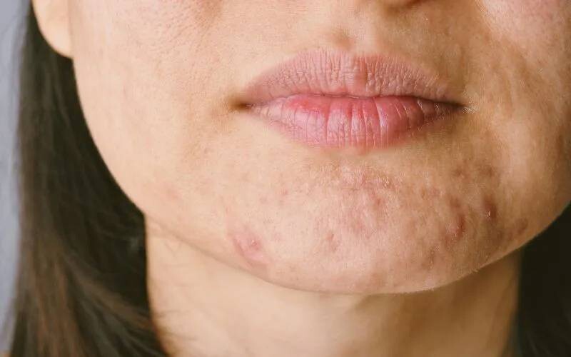 Mụn ẩn ở cằm: Nguyên nhân và cách trị mụn hiệu quả 3 - 3 Hướng dẫn các cách trị mụn ẩn ở cằm đơn giản mà hiệu quả.