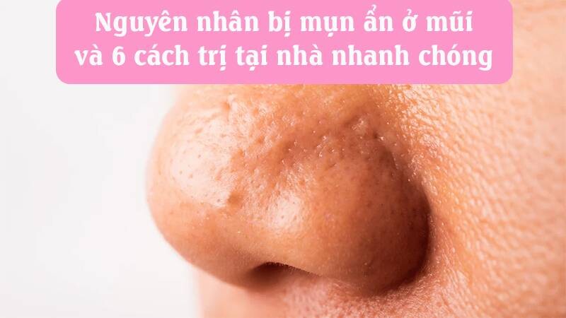 Mụn ẩn ở mũi: Nguyên nhân và 6 cách trị tại nhà nhanh chóng