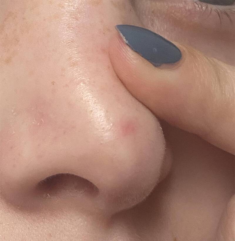 Mụn ẩn ở mũi: Nguyên nhân và 6 cách trị tại nhà nhanh chóng 2 - 2 Dấu hiệu nhận biết mụn ẩn mọc ở mũi.