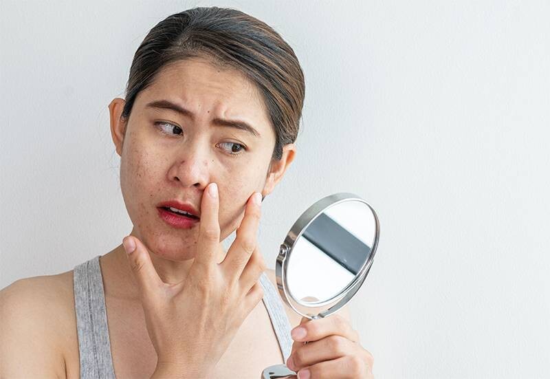 Mụn ẩn ở mũi: Nguyên nhân và 6 cách trị tại nhà nhanh chóng 3 - 3 Nguyên tắc khi trị mụn ẩn ở mũi là không được tự ý nặn mụn và sờ mụn nhiều.