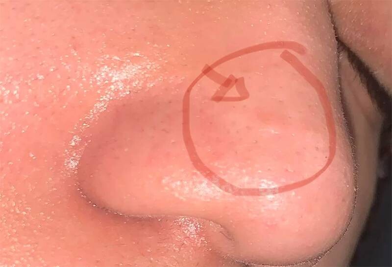 Mụn ẩn ở mũi: Nguyên nhân và 6 cách trị tại nhà nhanh chóng 1 - 1 Nguyên nhân mọc mụn ẩn trên mũi.