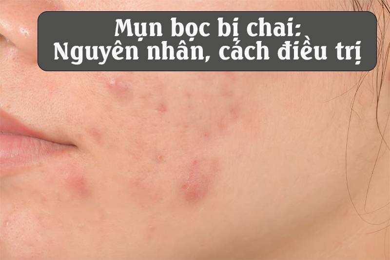 Mụn bọc bị chai: Nguyên nhân, cách điều trị dứt điểm
