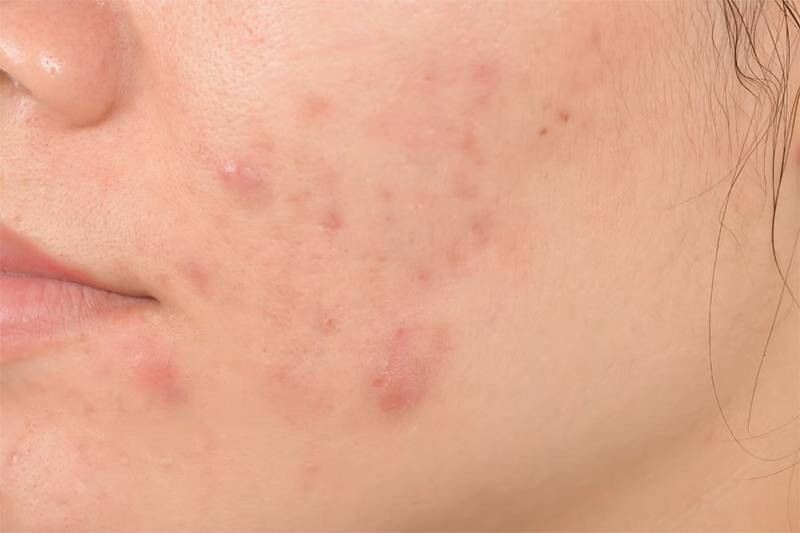 Dấu hiệu nhận biết mụn bọc chai cứng.