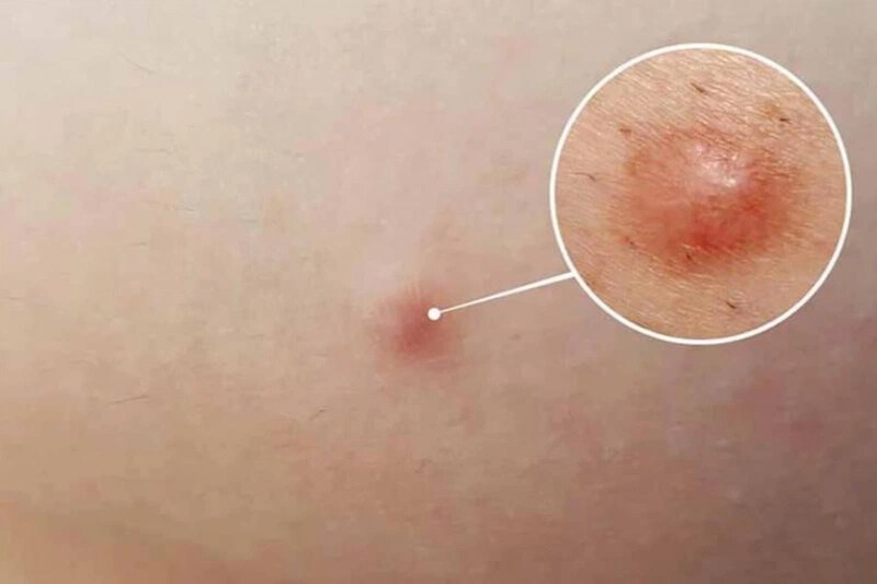 Trị mụn bọc bị chai cần các phương pháp chuyên sâu dưới sự chỉ định bác sĩ/chuyên gia da liễu.