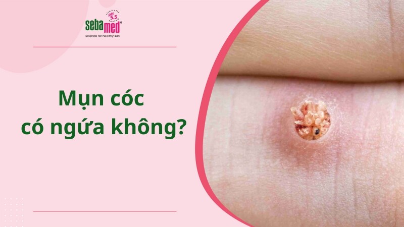 Mụn cóc có ngứa không?