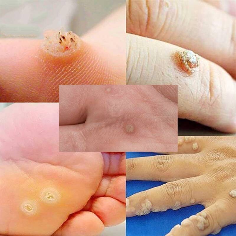 Mụn cóc có ngứa không? 2 - 2 Mụn cóc có ngứa không? Các loại mụn cóc phổ biến.