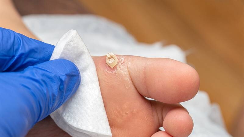 Mụn cóc có ngứa không? 4 - 4 Giảm ngứa mụn cóc tại nhà đơn giản.